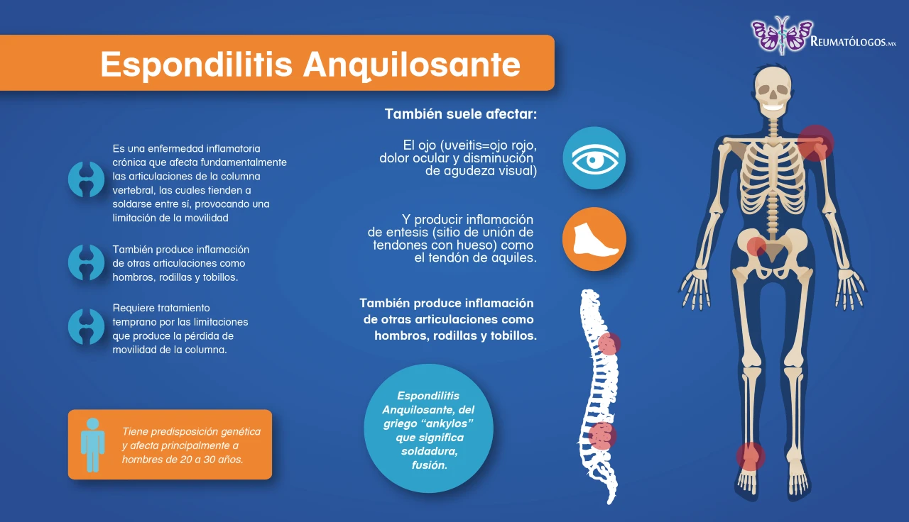 espondilitis anquilosante sintomas